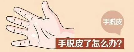手脱皮是什么原因导致的(手脱皮用什么药效果最好)