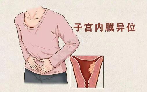 子宫内膜异位症(子宫内膜异位症做什么检查出来)